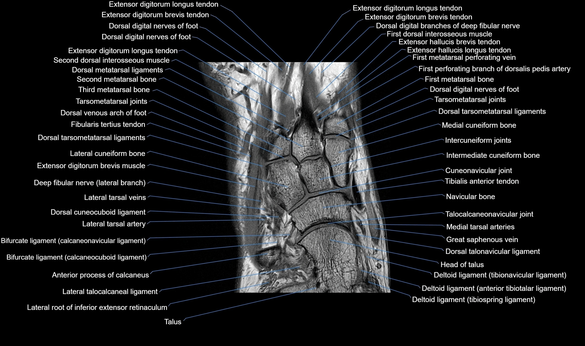 MRI mid foot coronal ligaments cross sectional anatomy 3T  radiology  image-img-00001-00016.webp